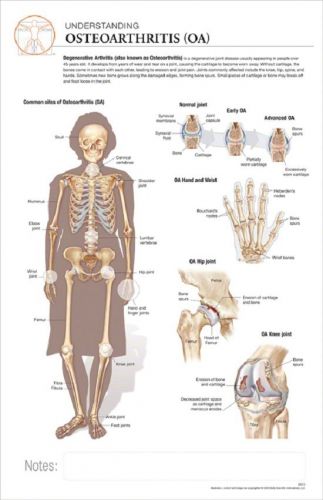 11 x 17 post-it disease chart:  osteoarthritis for sale