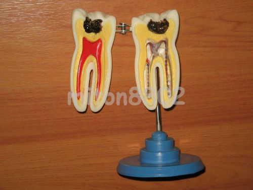 NEW MODEL GIANT MOLAR ANATOMICAL TOOTH DENTISTRY STUDY