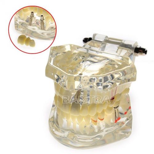 1PC Study Model Classic Implant Model with Restoration #2001 Dental