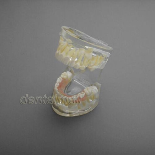 New Dental Model #3006 02 - Pediatric Orthodontic and Restoration Model