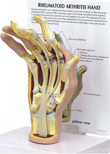 NEW Anatomical Rheumatoid Arthritis (AR) Hand Model