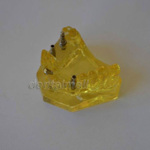Dentalmall Dental Model #2011 02 - Upper Jaw Implant Model