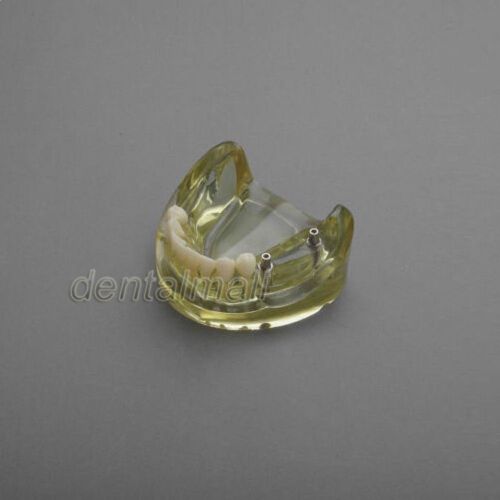 Dentalmall Dental Model #2011 01 - Lower Jaw Implant Model
