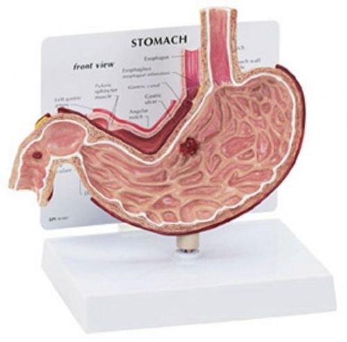 NEW Anatomical Stomach Gastric Model w/ Ulcers