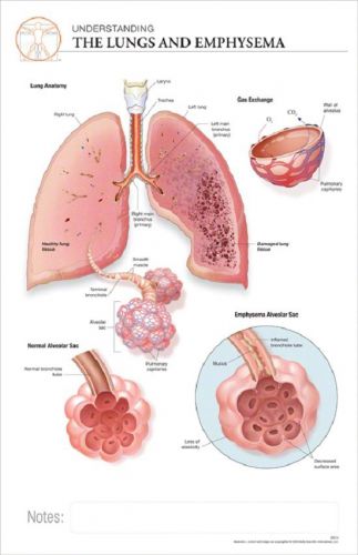11 x 17 Post-It Disease Chart: Lungs &amp; EMPHYSEMA