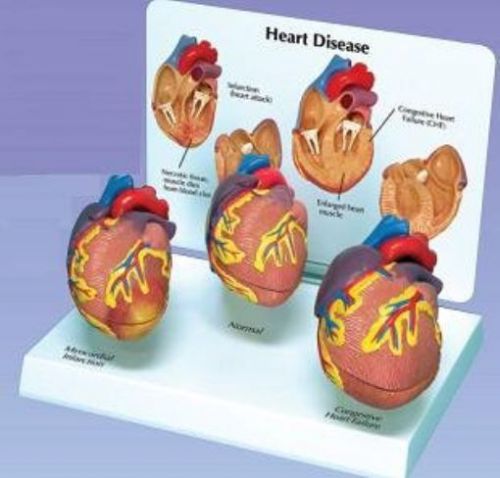 NEW 3 Piece Mini Heart Disease Anatomical Model #2550