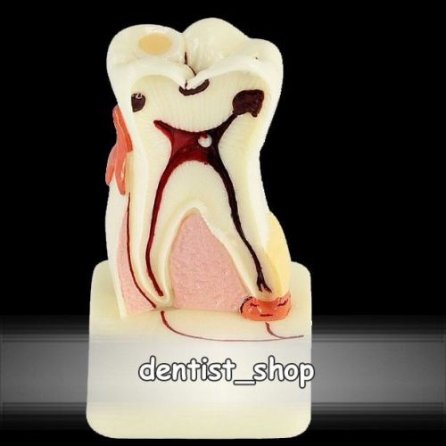 FREE SHIPPING 4-Times Oral Periodontal Pathology Tooth Model #4015
