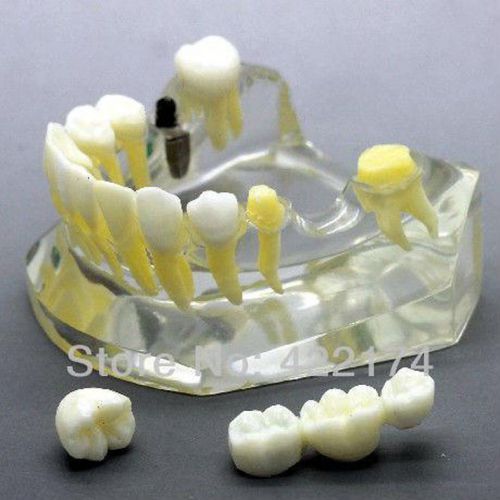 Implant model with bridge and caries dental tooth teeth anatomical anatomy model