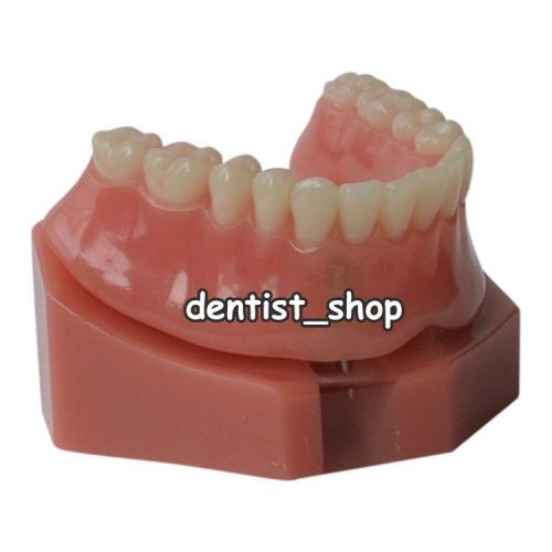 Dental Overdenture Model Inferior with 2 Implants Demo Tooth Model
