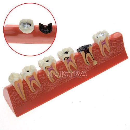 1Pc Dental six stages Caries Demonstration Teaching teeth model #4011