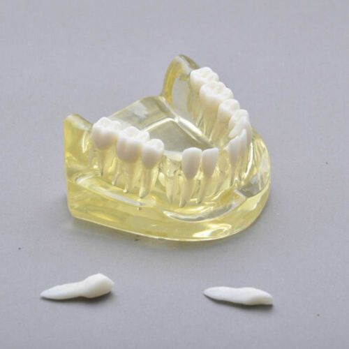 Dentalmall Dental Model #7006 01 - Dental Model with Removable Teeth