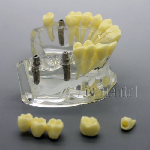 Dental study model Implant model with bridge and caries