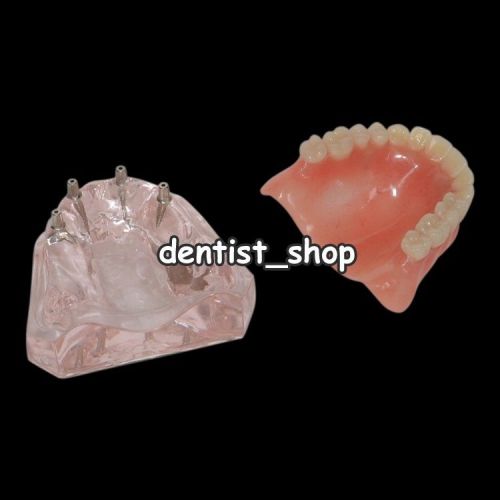 Dental Overdenture Teeth Model Superior with 4 Implants