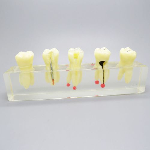 Dental Teeth Study Teaching Model Endodontic Treatment Demonstration #4012-01