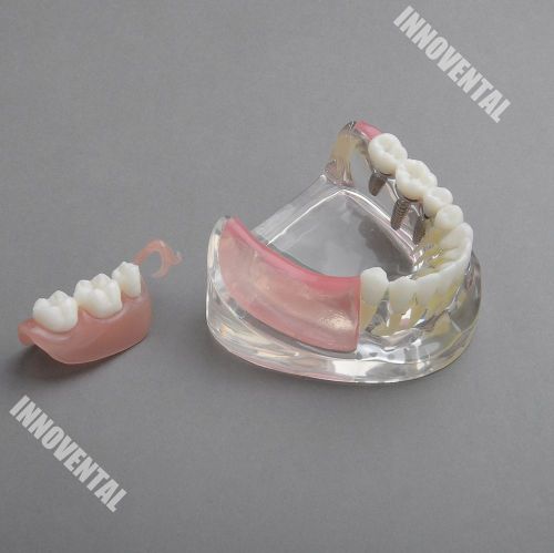 Dental Model  #6006 01 - Lower Jaw Implant &amp; Unilateral Denture
