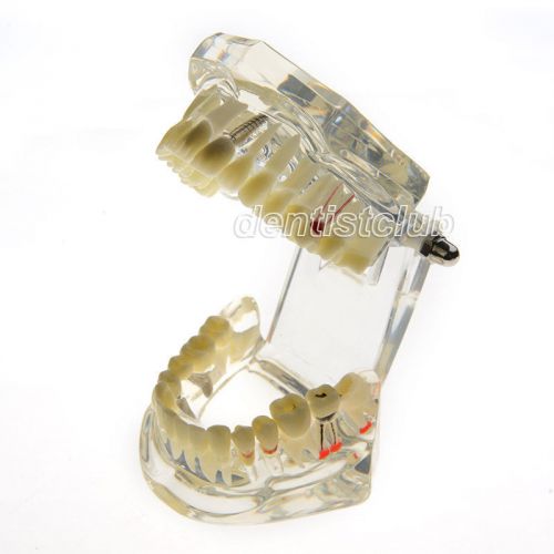New dental study model classic implant model with restoration #2001 for sale