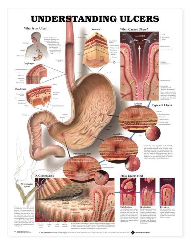 Understanding Ulcers * GI * Anatomy Poster * Anatomical Chart Company