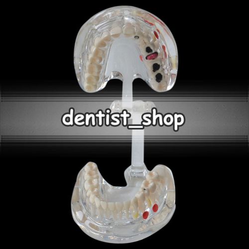 Transparent Oral Pathology Dental Teeth Model w/ Restoration A19