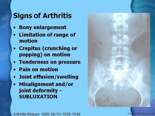 THE CHIROPRACTIC ARTHRITIS POWERPOINT LECTURE! - SEE300AWEEK - 104 SLIDES