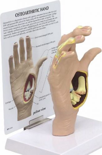NEW Anatomical Osteoarthritis (OA) Hand Model