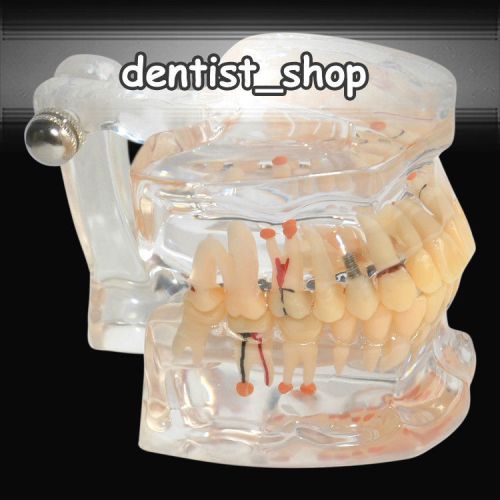 Transparent Adult Pathology Teeth Model with Half Implant Demonstration Model