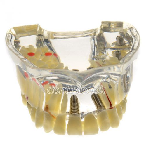 New dental dentist teeth study implant model Bridge and Caries #2006