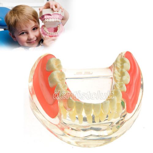 New Implant Restoration Model Dental Dentist Teeth Tooth Model #6006