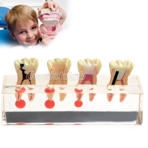 Dental Endodontic Treatment Model for pulposis Study Teach teeth model #4018