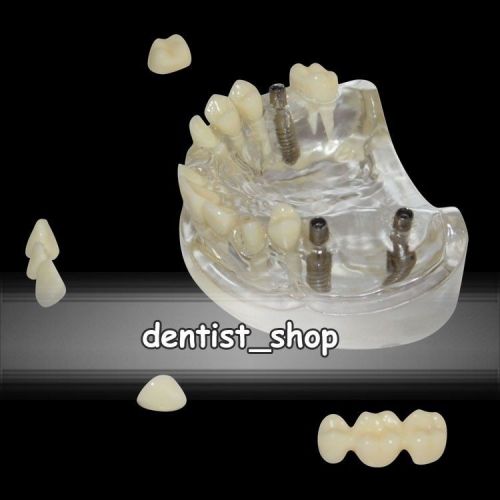 Dental Molar Implant Communication Teeth Model with Crown Bridge &amp; Restoration