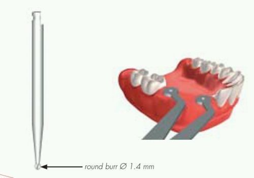 2015 dental implant diameter gauges straumann 3i nobel astra adin ab alphabio for sale