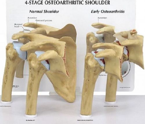 New anatomical 4-stage osteoarthritis (oa) shoulder model for sale