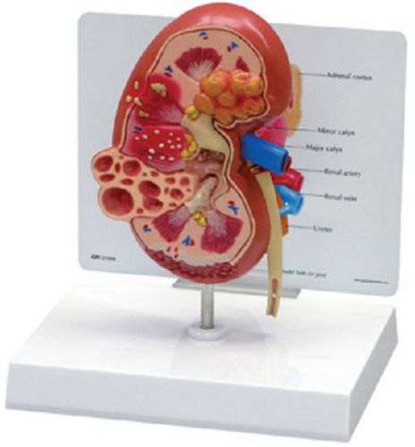 NEW Anatomical Human Diseased Kidney Cancer Model