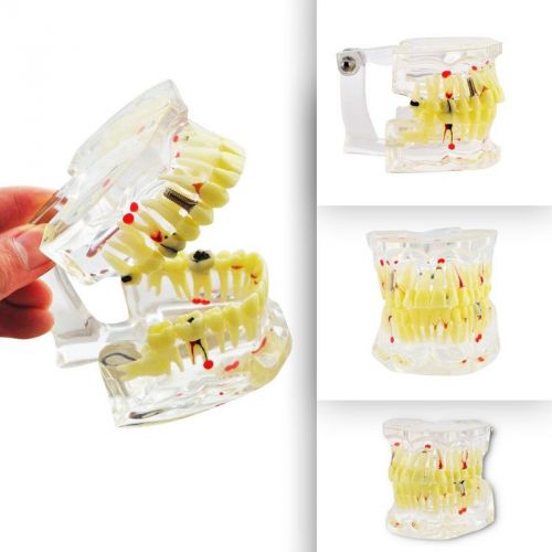 New dental study tooth transparent pathological teeth model for sale