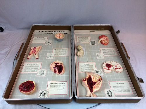 Anatomical Models - The Consequences of High Blood Pressure 3-D Display