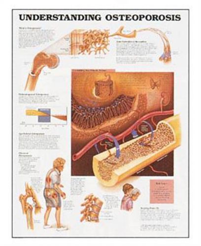 Understanding Osteoporosis * Anatomy Poster * Anatomical Chart Company