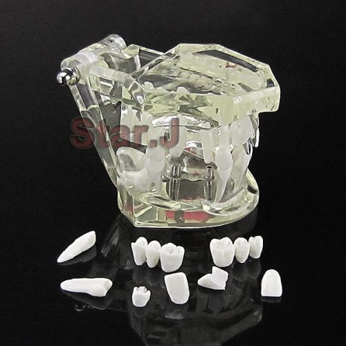 New dental implant study analysis demonstration teeth model with restoration for sale