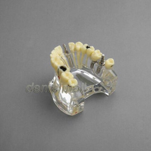 Dental Model #2008 01 - Upper Jaw Implant Model with Bridge and Caries -III