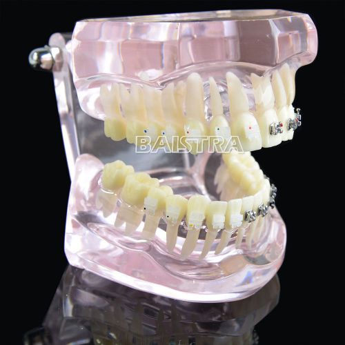 Dental Orthodontic Study Teach Teeth Model ZYR-3003 Metal Ceramic Bracket Brace