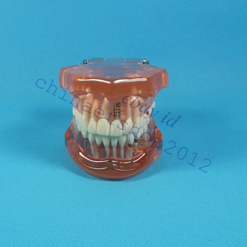 Dental Implant Disease Tooth Pathological Missing Teeth Model maryland
