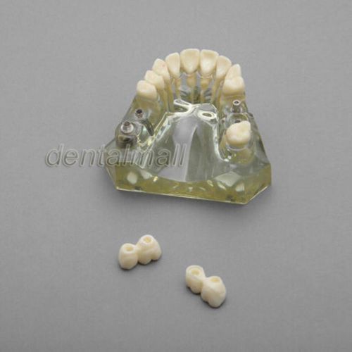 Dental Model #2010 02 - Upper Jaw Implant Model with Bridge