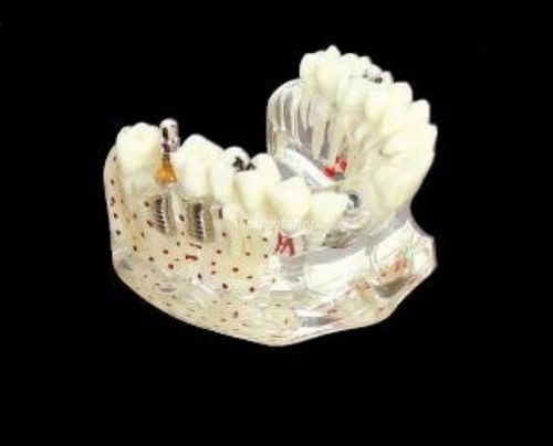 1*XINGXING Dental Dentist Implant Model With Bone And Caries 2007 CE