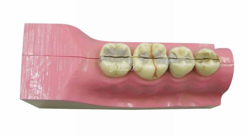 New Dental Demonstration Model Molar Cross Section Teeth Study Model G115 PT
