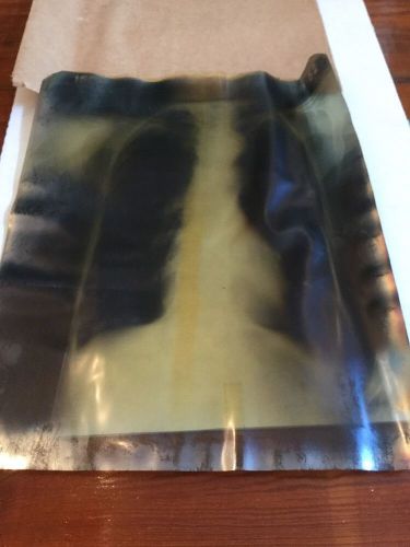 Vintage Medical Chest X-Ray Film Dated 1952 COPD - 17&#034; X 14&#034;