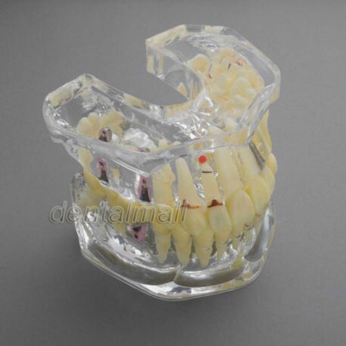 Dental model #6004 01 - enlarged implant and restoration study model for sale