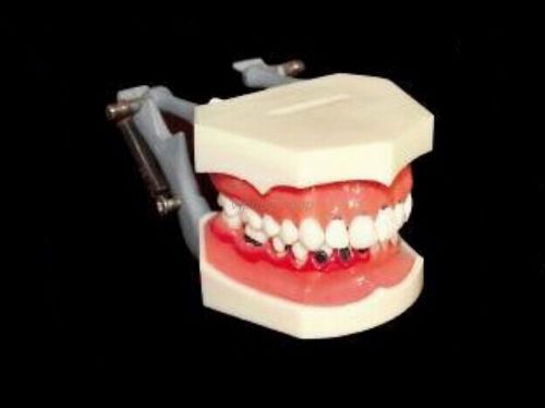 1*XINGXING Dental Study Teaching Periodontosis Model 4003 CE