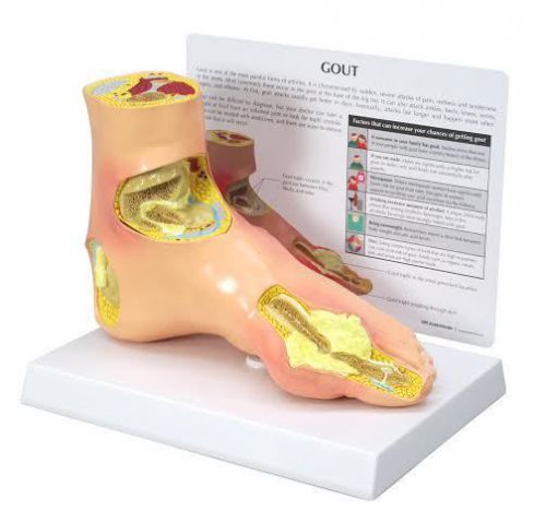 Foot with tophi anatomical model w key card lfa #1985 ** for sale