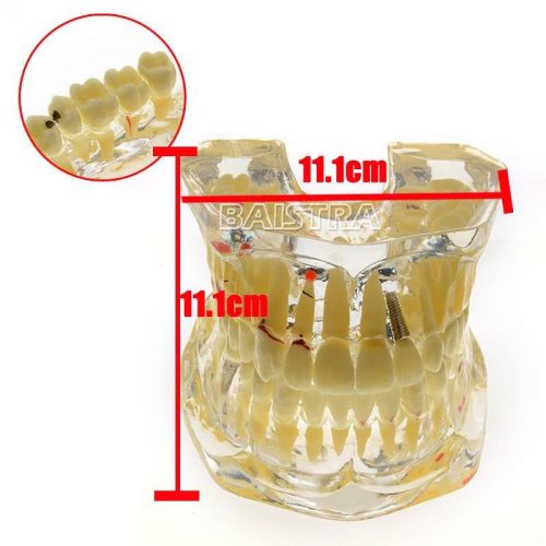 SALE Dental 2 Times Natural Size Adult Pathologies Demonstrates Teeth Model 4005