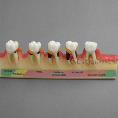 New Dental Model #4010-5-Stage Periodontitis Model (Bulk Package)