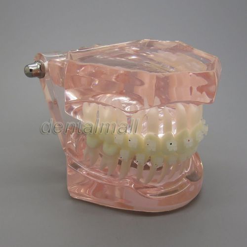 Dentalmall 1:1 Dental study orthodontics study model with ceramic brackets 3002