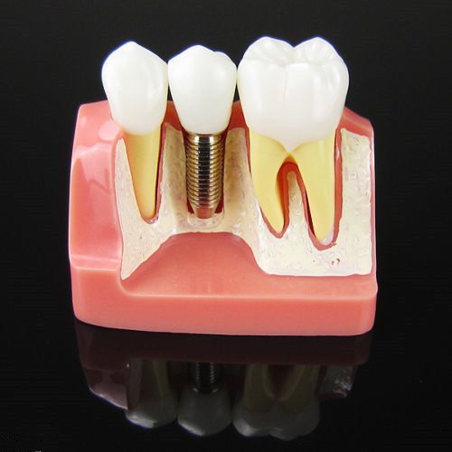 Brand NEW Dental Implant Analysis Crown Bridge Demonstration Teeth Model bling